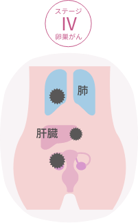 ステージⅣ卵巣がん